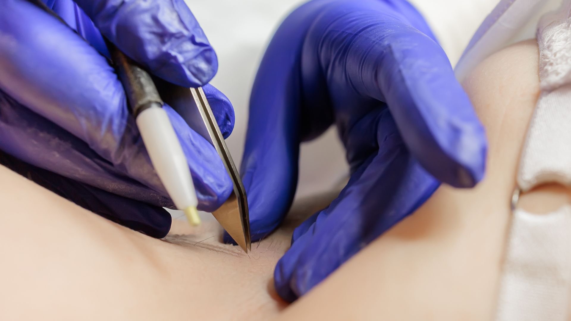 Medical professional performing a procedure with surgical gloves and instruments